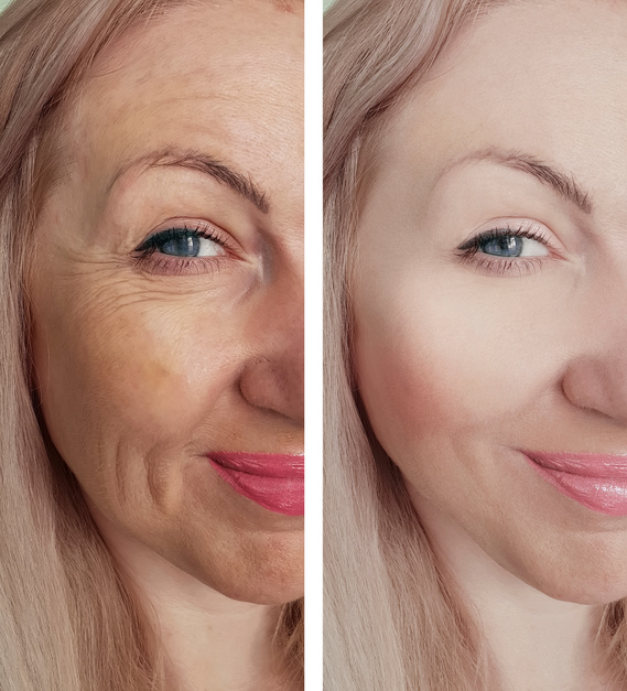 woman face wrinkles before and after treatments